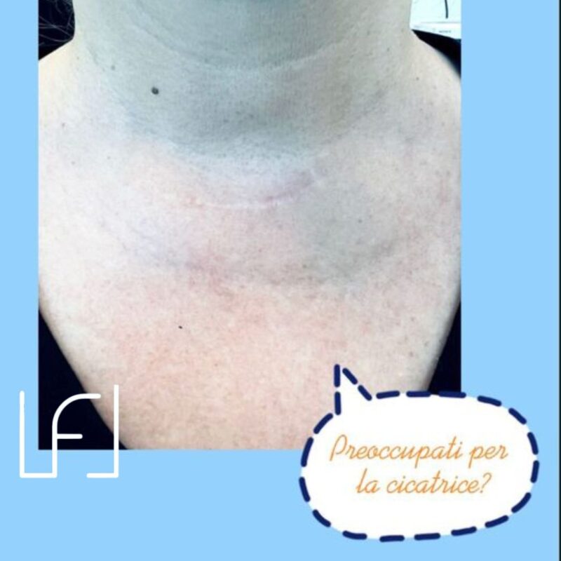 La cicatrice in caso di operazione alla tiroide